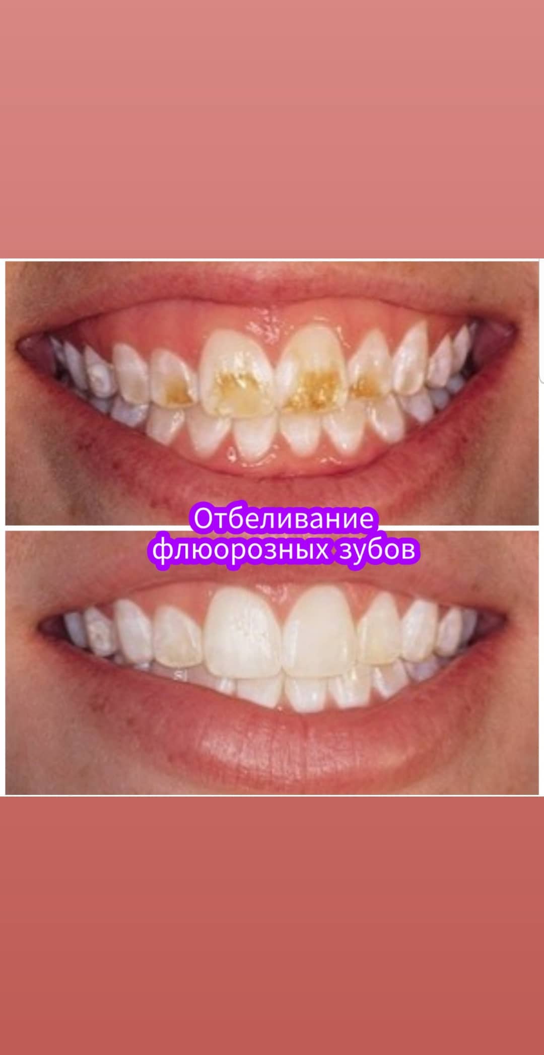 Отбеливание зубов