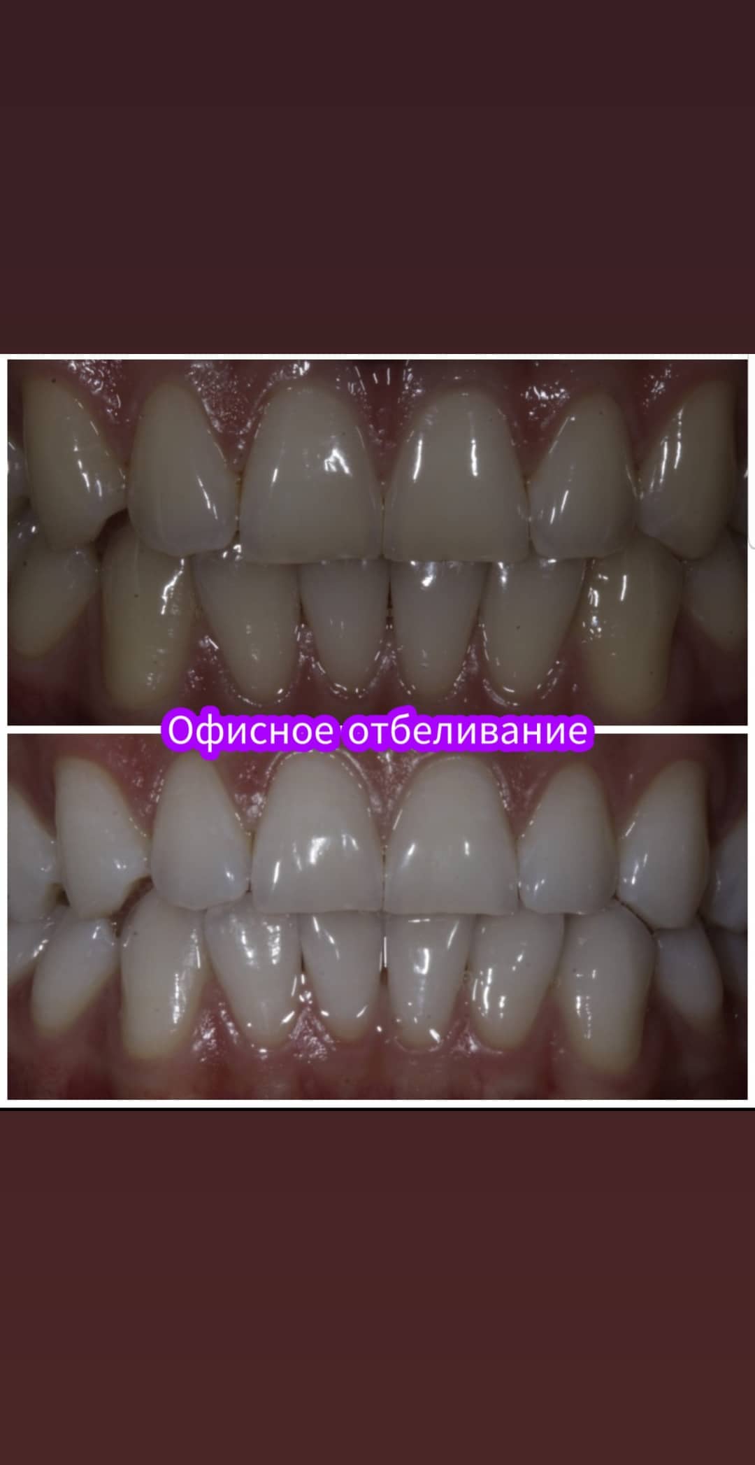 Отбеливание