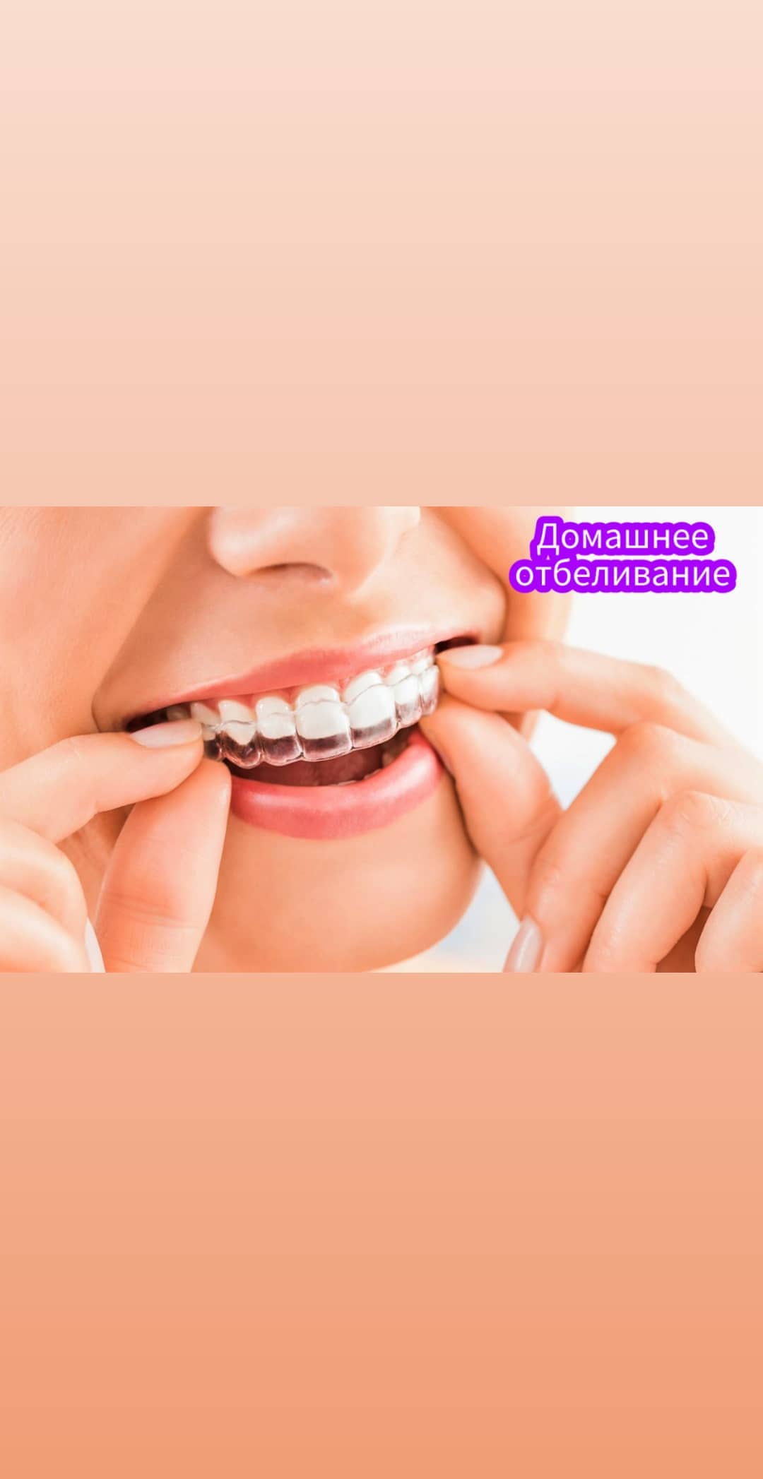 Реплантация зубов