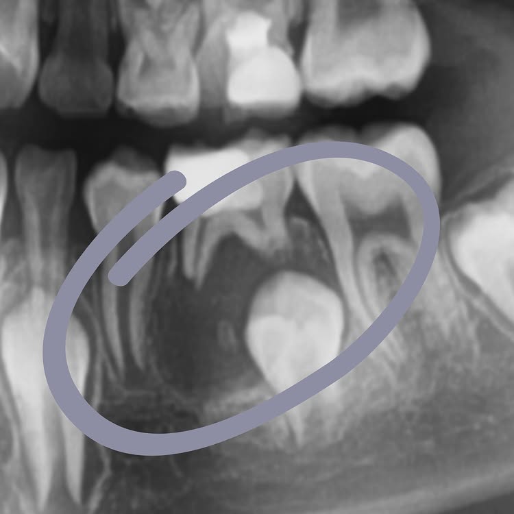 Удаление кисты