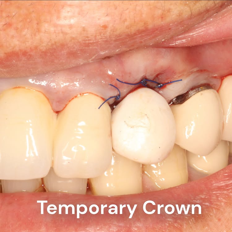 Немедленная имплантация